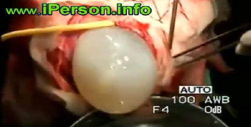 吃脑寄生虫