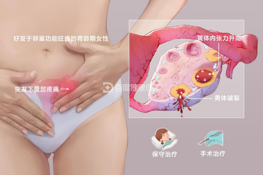 黄体破裂