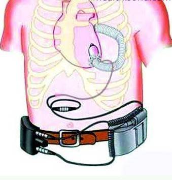 异位心脏移植手术