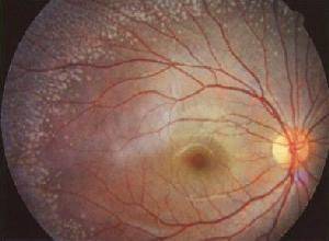 视网膜神经炎