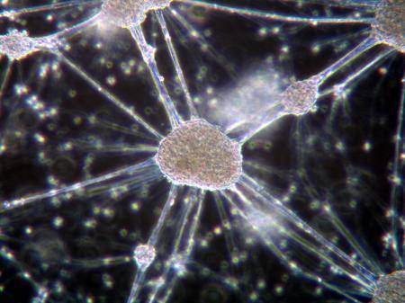 骨髓瘤管型肾病