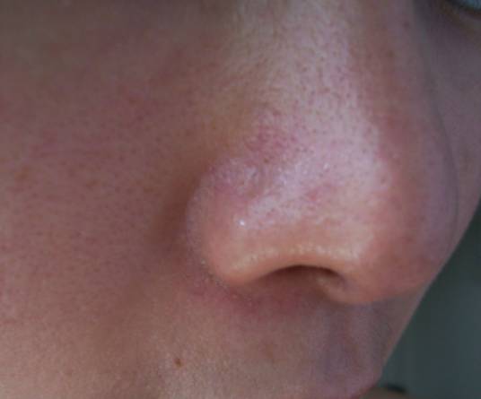 裸脸治疗激素依赖性皮炎