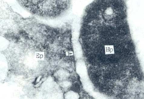 小儿幽门螺杆菌感染