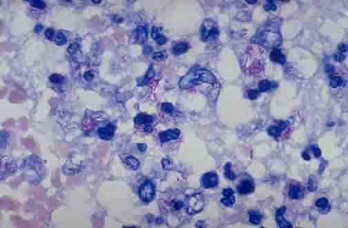 非结核分支杆菌