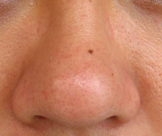 黑头(黑头粉刺)