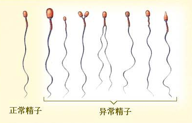 精子精液异常