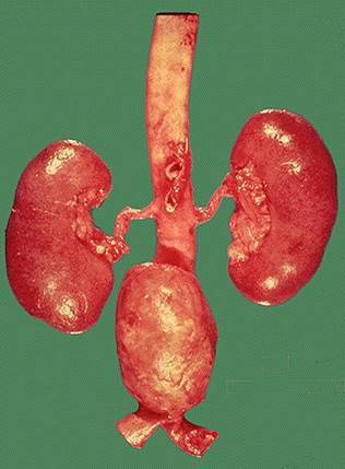 肾动脉粥样硬化